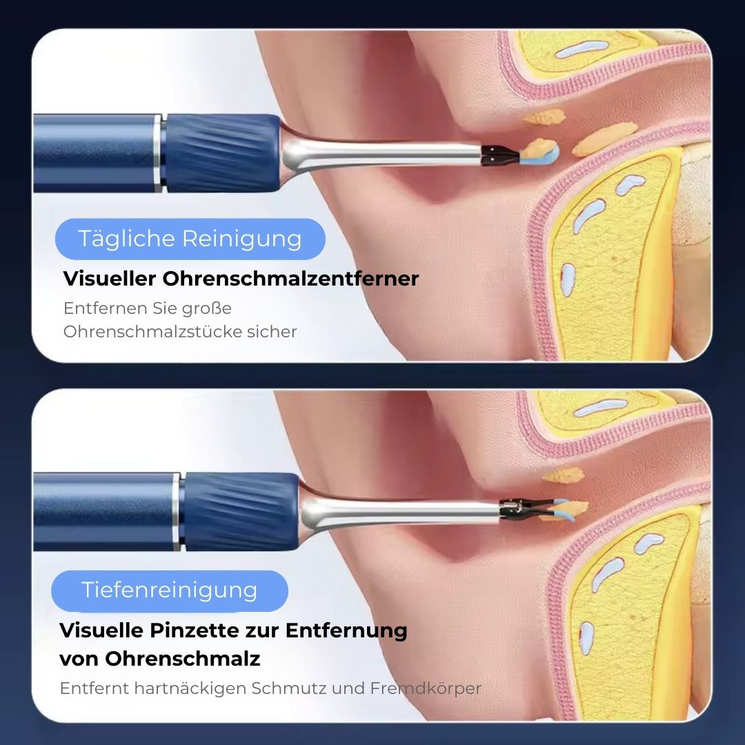 Smart Ohrreiniger – kabellos mit Kamera (Android/iOS)